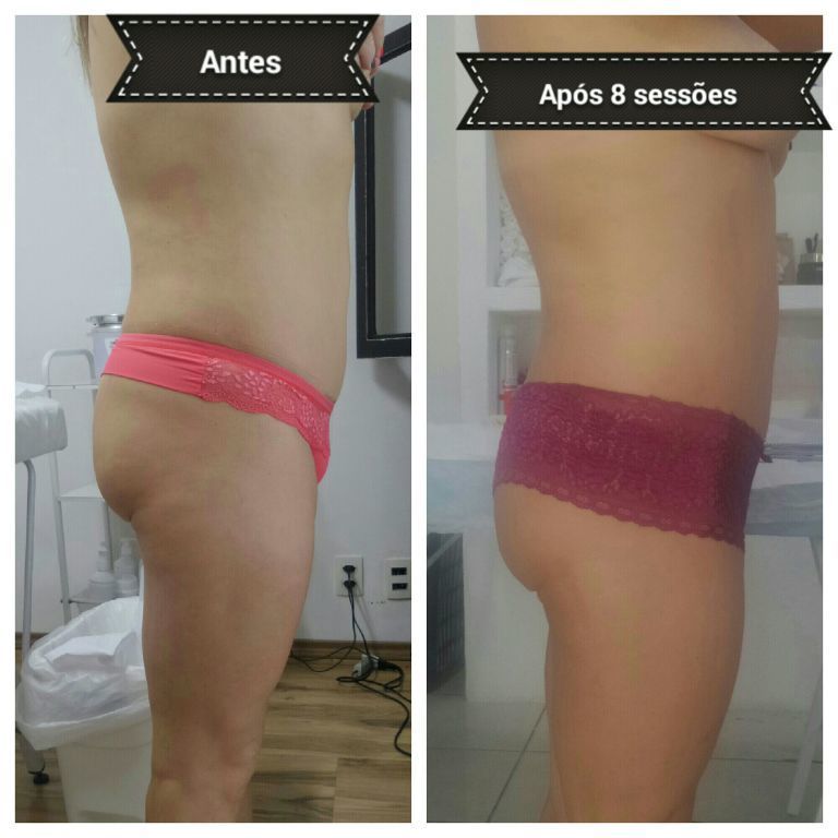 Tratamento corporal!!  Drenagem linfática conciliada de protocolos para gordura localizada e celulite estética esteticista esteticista designer de sobrancelhas depilador(a)