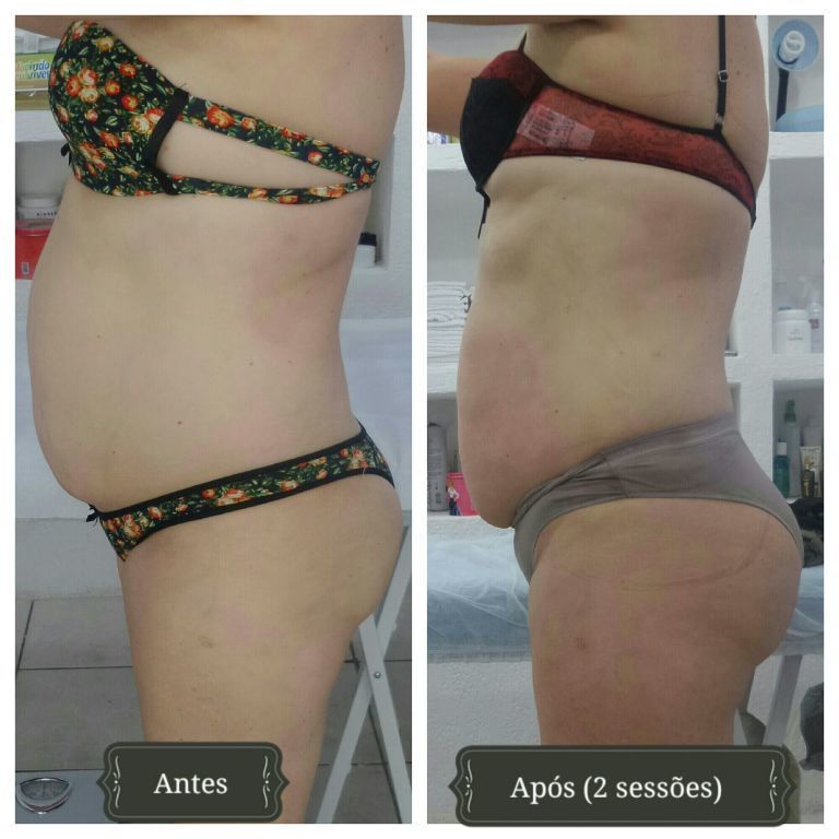 Tratamento corporal!!  Drenagem linfática, indica para retenção de líquidos e toxinas. estética esteticista esteticista designer de sobrancelhas depilador(a)