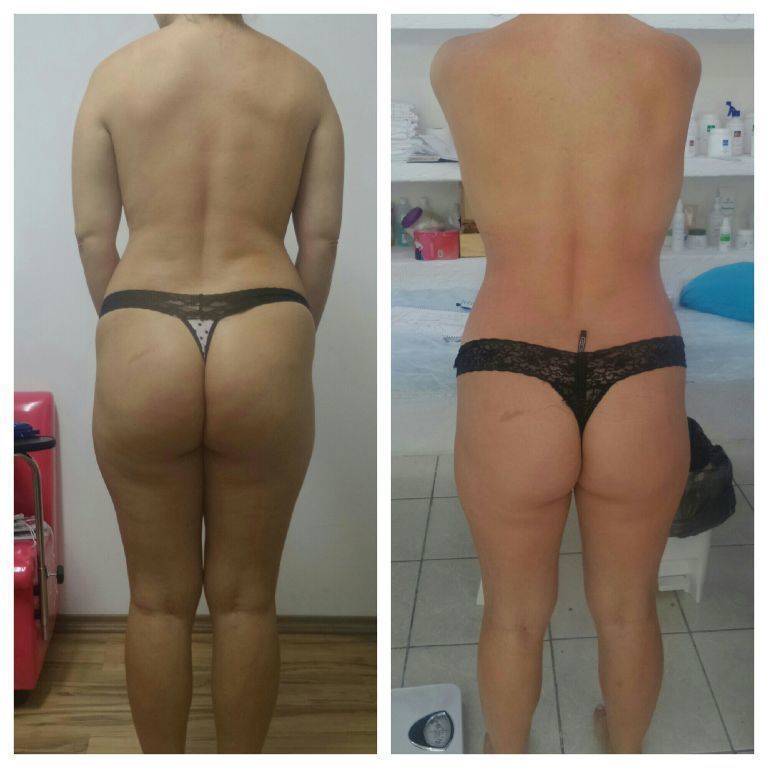 Tratamento corporal!! Drenagem linfática conciliada de protocolos para gordura localizada e celulite!! (Antes e Depois em 10 sessões) estética esteticista esteticista designer de sobrancelhas depilador(a)