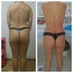 Tratamento corporal!! Drenagem linfática conciliada de protocolos para gordura localizada e celulite!! (Antes e Depois em 10 sessões)