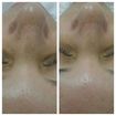 Antes e Depois - Limpeza de Pele - adequada a cada tipo de pele,  essa por exemplo é uma pele  extremamente oleosa e com muitos comedões.