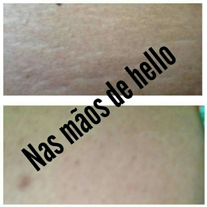 Fim das estrias estética esteticista massoterapeuta
