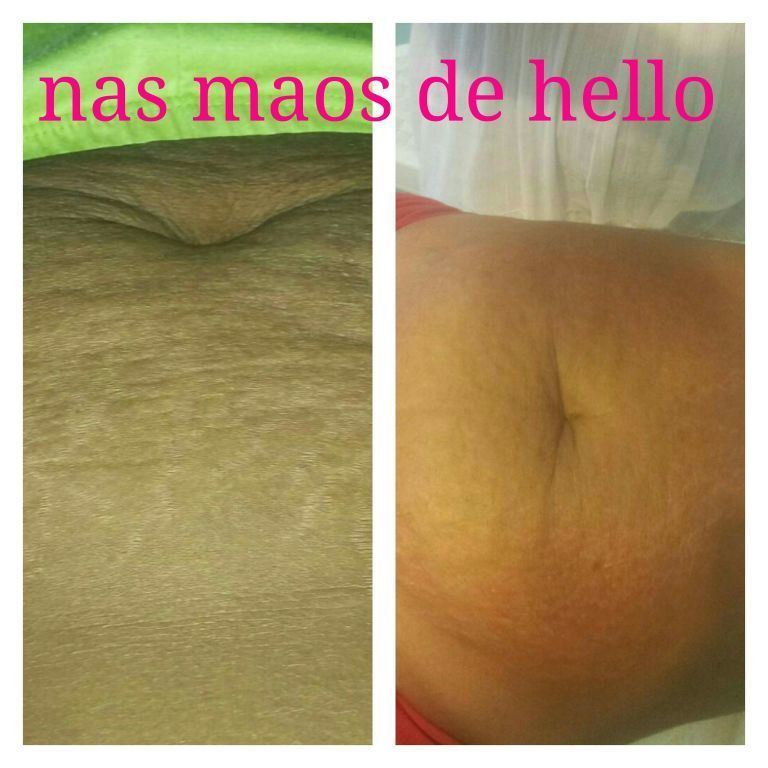 Amento de estrias ,antes e depois da 1 sessao esteticista massoterapeuta