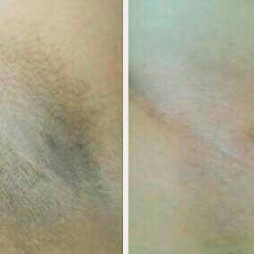 Clareamento de auxilia estética esteticista massoterapeuta
