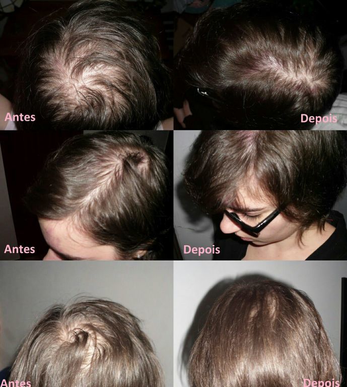 Tratamento de calvice tratamento  cabelo  esteticista