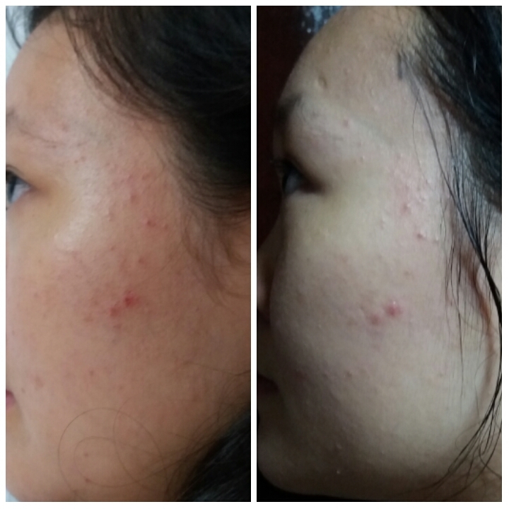 Tratamento Acne! esteticista maquiador(a) massoterapeuta gerente administrativo designer de sobrancelhas aromaterapeuta vendedor(a) cosmetólogo(a) consultor(a) docente / professor(a)