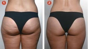 Tratamento de Drenagem esteticista micropigmentador(a) designer de sobrancelhas