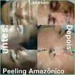 Tratamento de redução linhas expressão com peeling diamante, e peeling Amazônico