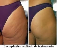 TRATAMENTO DE CELULITES COM ELETROLIPÓLISE: ANTES E DEPOIS estética fisioterapeuta