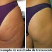 TRATAMENTO DE CELULITES COM ELETROLIPÓLISE: ANTES E DEPOIS