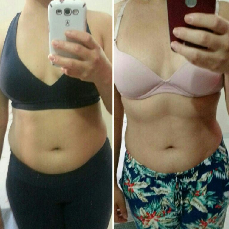 Antes e depois do tratamento com criolipolise na região abdominal, resultado após 1 mês da aplicação. estética fisioterapeuta