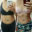 Antes e depois do tratamento com criolipolise na região abdominal, resultado após 1 mês da aplicação.