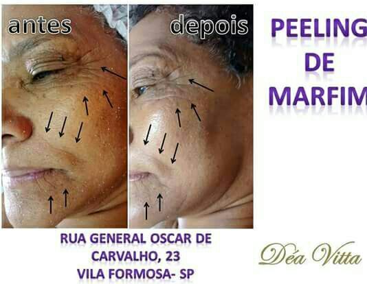 Aplicação do perling de marfim . estética fisioterapeuta