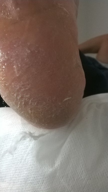 Tratamento de hiperqueratose.
 outros podólogo(a) manicure e pedicure