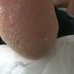 Tratamento de hiperqueratose.
