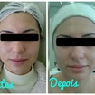 Tratamento para acne.