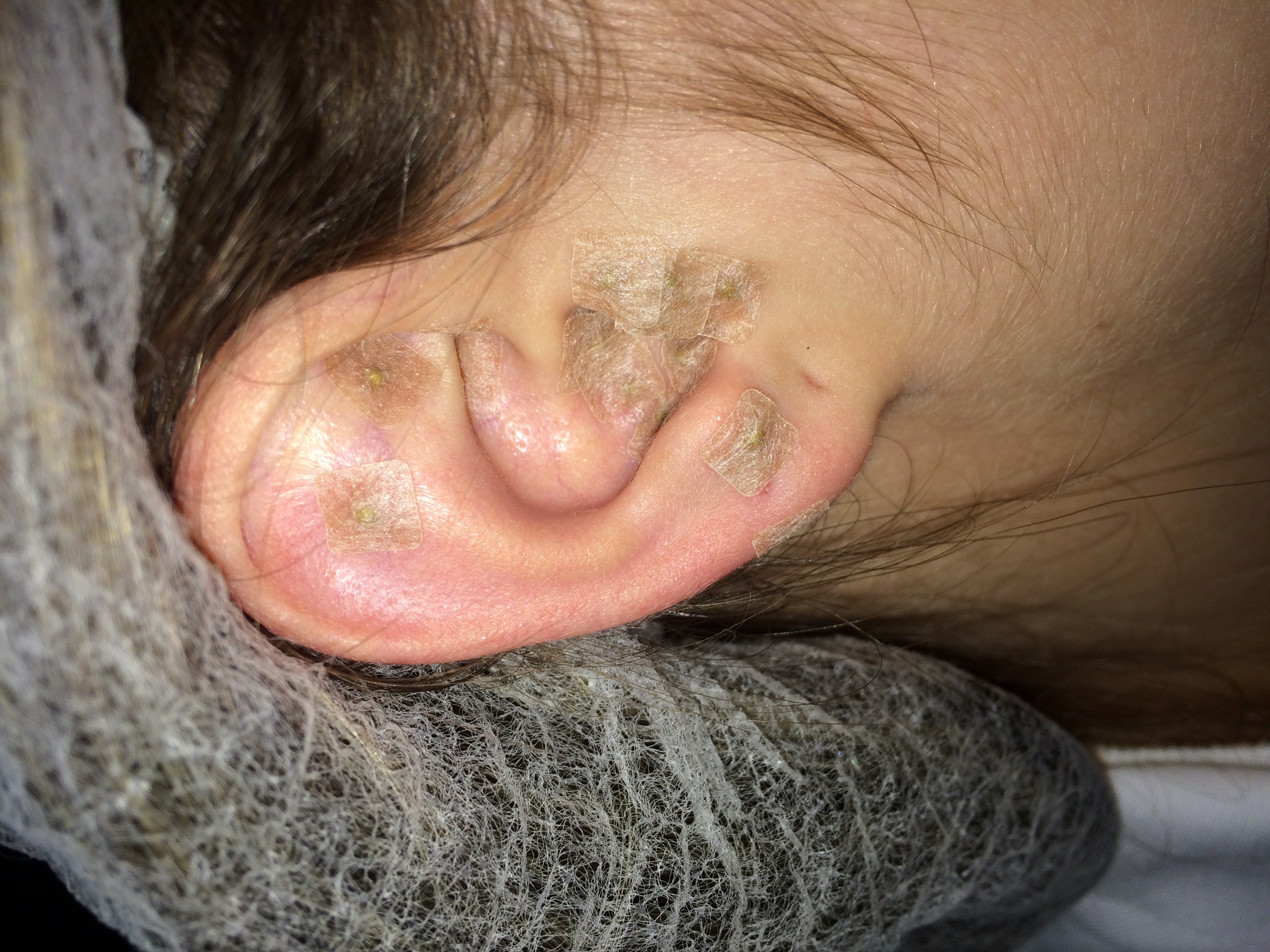 Técnica chinesa, utilizada com semente de mostarda. Pontos utilizados: Triângulo cibernético (Shenmen, rim e simpático) + Emagrecimento. estética esteticista depilador(a)