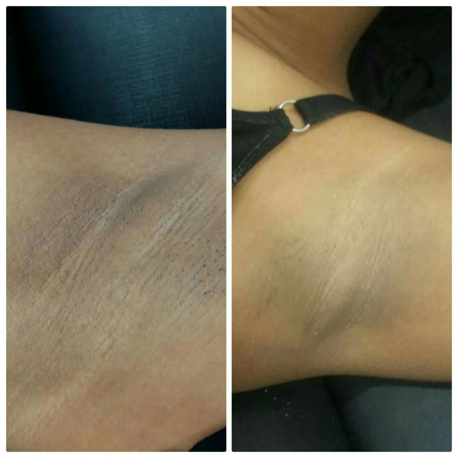 Clareamento de axilas estética massoterapeuta designer de sobrancelhas depilador(a)