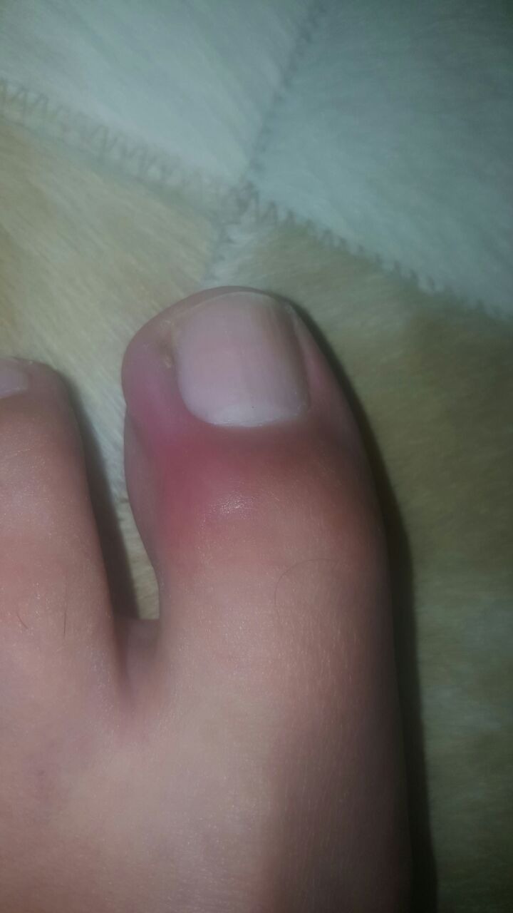 Paciente com granuloma,  unha podólogo(a)