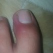Paciente com granuloma, 