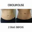 #criolipolise
#resultado
#2dias depois