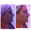Antes e depois de um protocolo de peeling para marcas de expressão e uniformização da pele.
