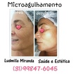 Tratamento de rejuvenescimento com microagulhamento e Micropuntura