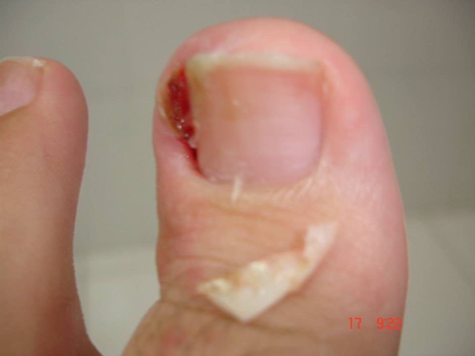 Onicocriptose - unha encravada e infeccionada unha podólogo(a) micropigmentador(a)