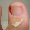 Onicocriptose - unha encravada e infeccionada