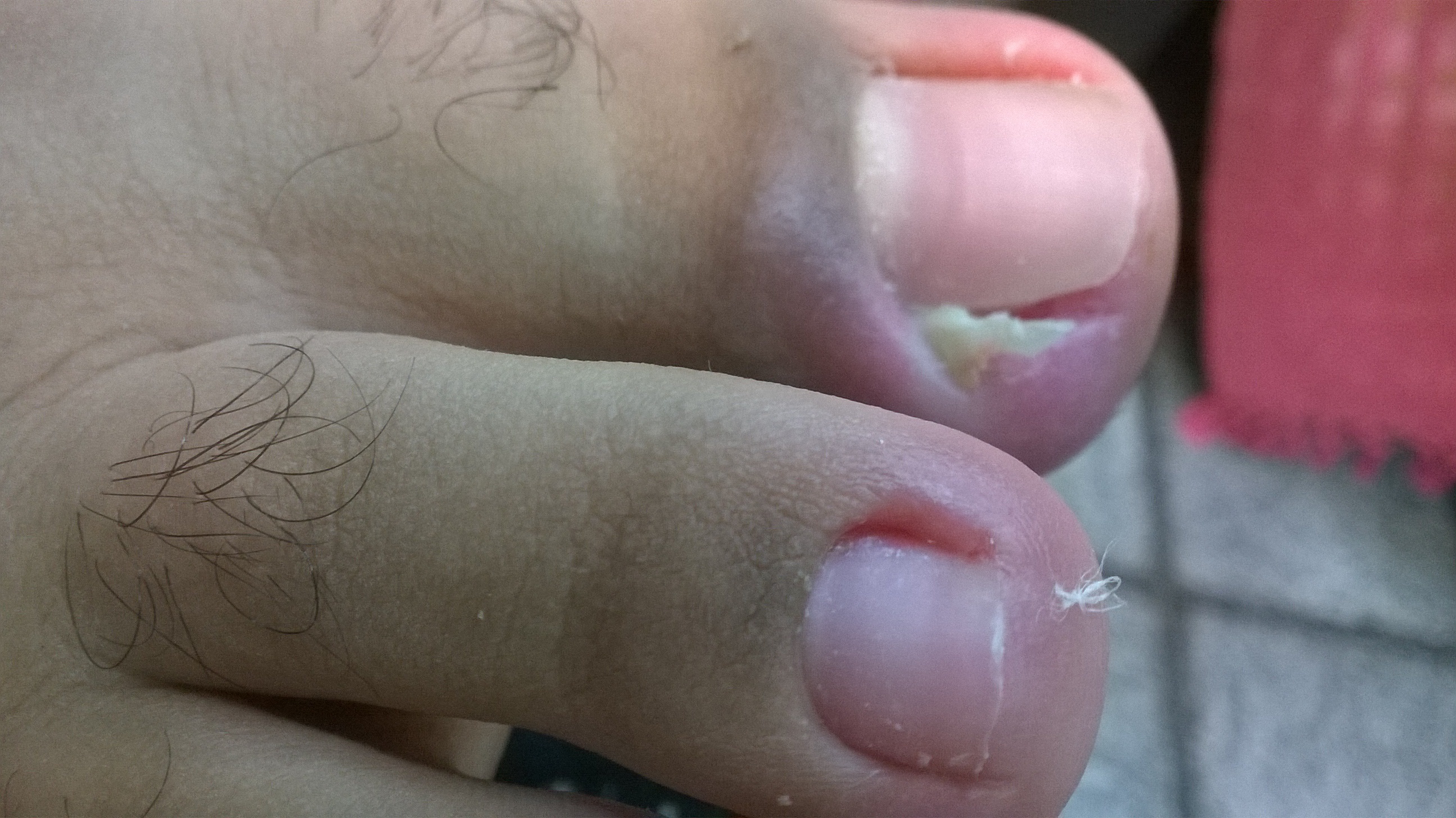 Retirada de espículas. Olha o tamanhoooooo adoro. Infecções amo muito. Alivio imediato. unha podólogo(a) manicure e pedicure