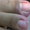 Retirada de espículas. Olha o tamanhoooooo adoro. Infecções amo muito. Alivio imediato.