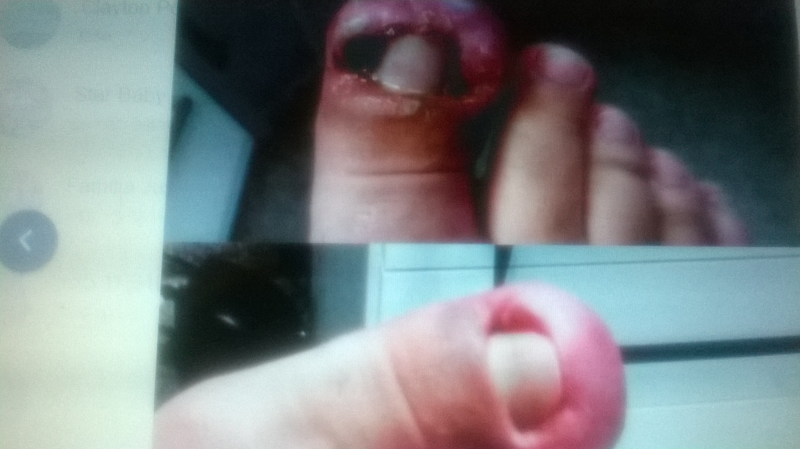 Pé com infecções e depois cicatrizado  . Para um bom tratamento cliente  também tem que fazer sua parte. unha podólogo(a) manicure e pedicure