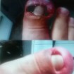 Pé com infecções e depois cicatrizado  . Para um bom tratamento cliente  também tem que fazer sua parte.