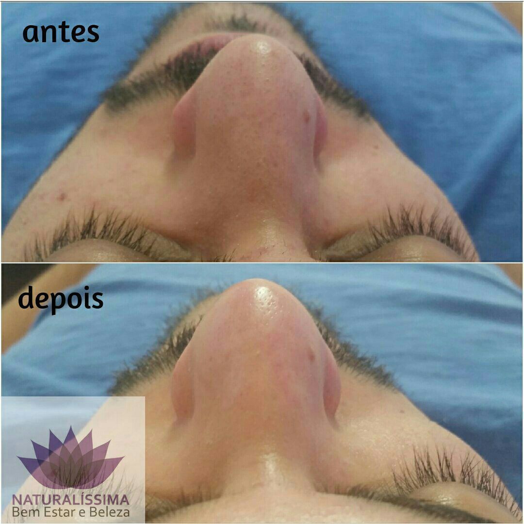 Limpeza de Pele estética cosmetólogo(a) esteticista aromaterapeuta