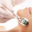 Tratamentos faciais com e sem microagulhamento  e PEELING  para o ano todo