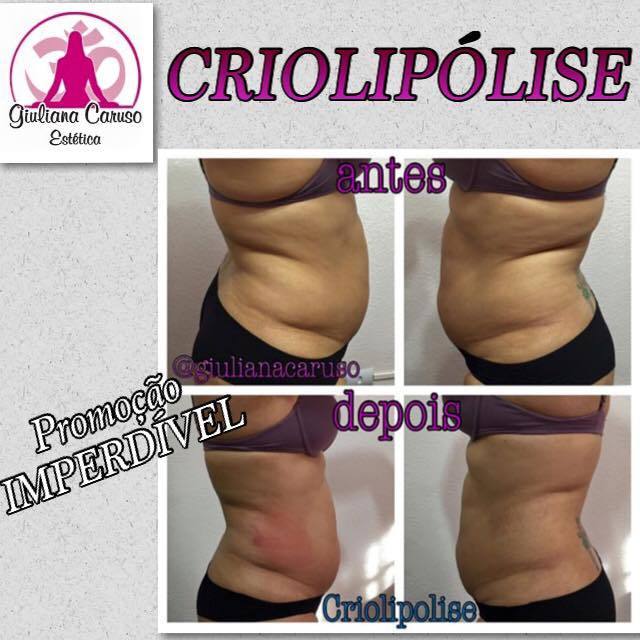 Antes e depois do procedimento de criolipólise estética esteticista designer de sobrancelhas