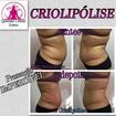 Antes e depois do procedimento de criolipólise