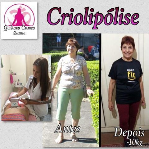 Antes e depois dos procedimentos corporais para emagrecimento. estética esteticista designer de sobrancelhas