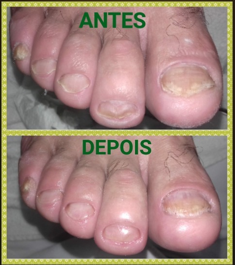 Profilaxia Podal (corte e desbaste das lâminas ) podólogo(a) manicure e pedicure