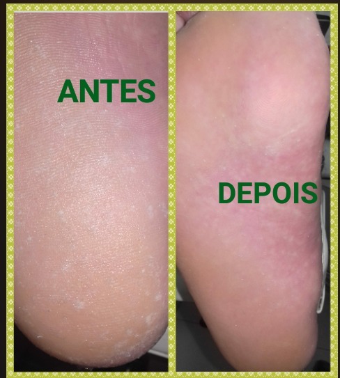 Profilaxia Podal (restirada do excesso de queratose e da parte plantar) estética podólogo(a) manicure e pedicure