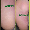 Profilaxia Podal (restirada do excesso de queratose e da parte plantar)