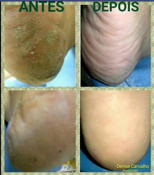 Mais uma profilaxia (excesso de queratose já com pequenas fissuras, na região do calcaneo) podólogo(a) manicure e pedicure