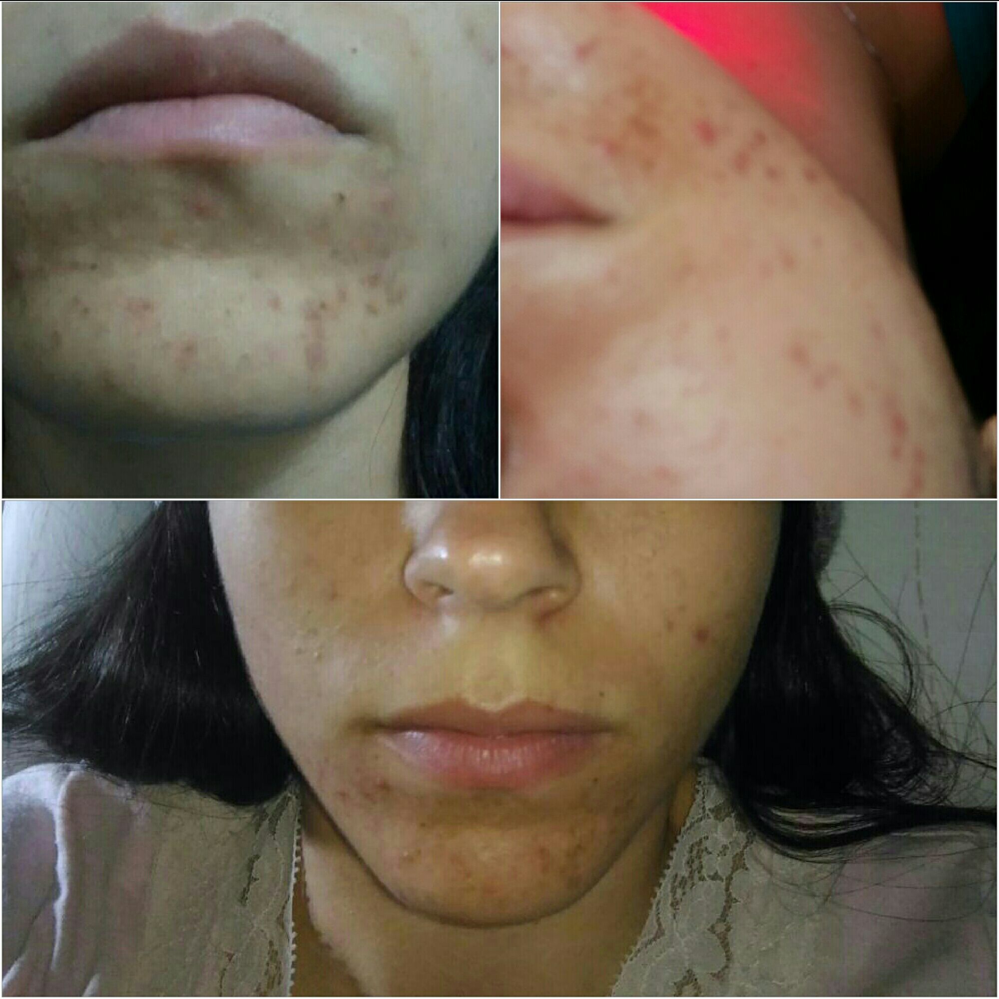 Tratamento de acne e sequelas estética cosmetólogo(a) esteticista aromaterapeuta