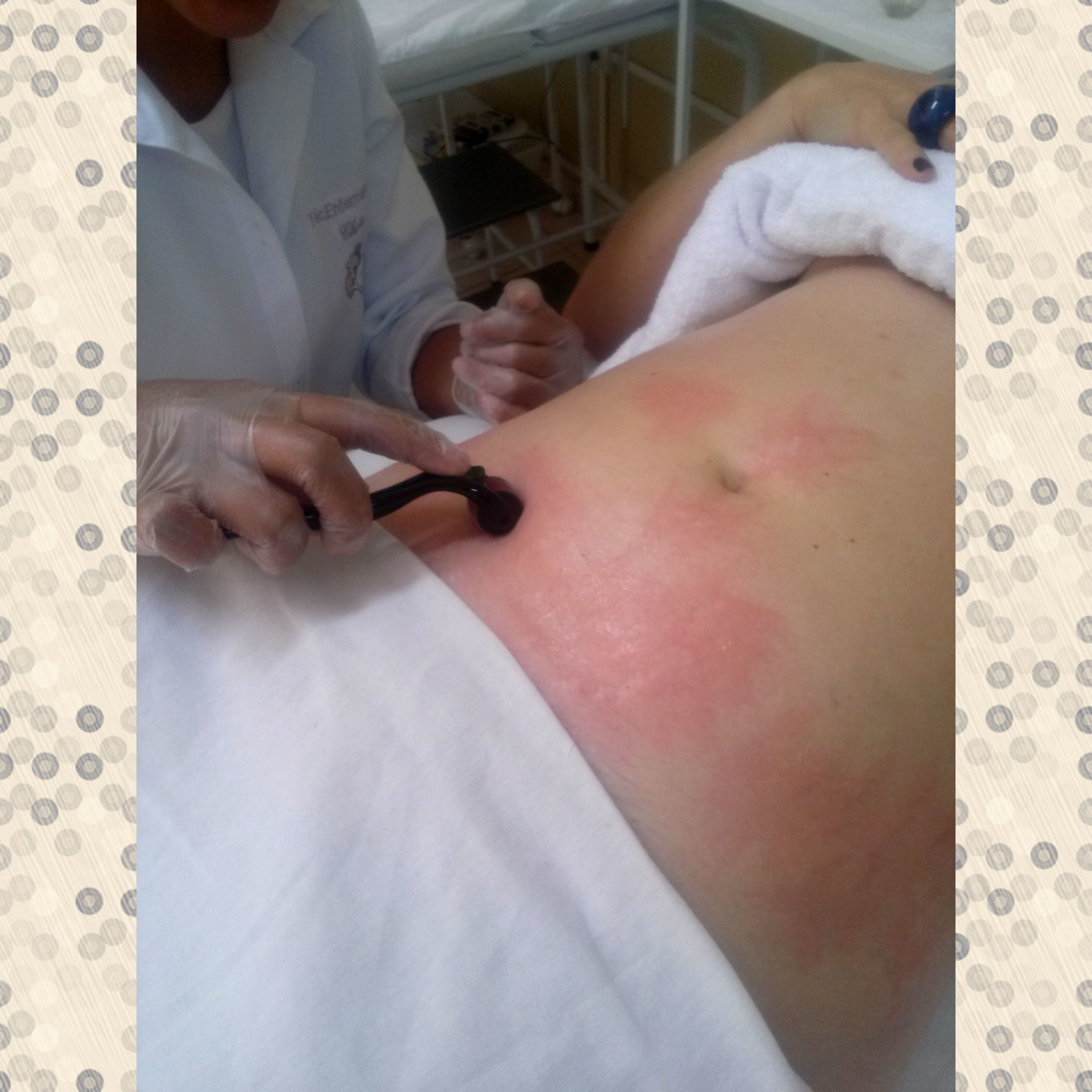 Microagulhamento para estrias. estética esteticista gerente depilador(a)