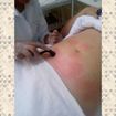 Microagulhamento para estrias.