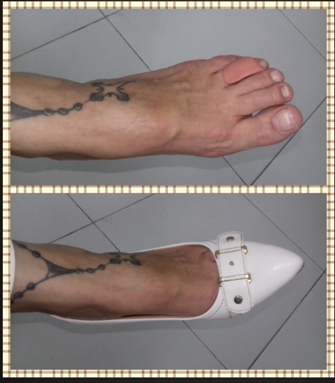 Cliente satisfeita com sua órtese em interdigital. Cliente: antes eu ñ conseguia usar salto, agora eu coloquei esse com bico fino e me sinto bem confortável. 
Grata pelo reconhecimento. estética podólogo(a) manicure e pedicure