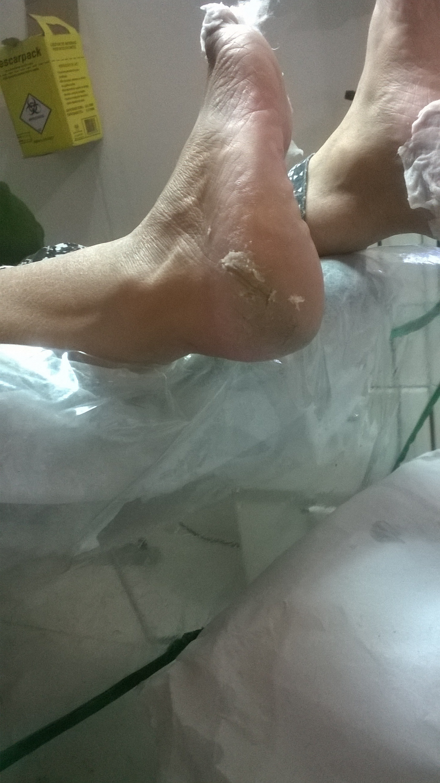 fissuras eu dou um fimmmmmm unha podólogo(a) manicure e pedicure