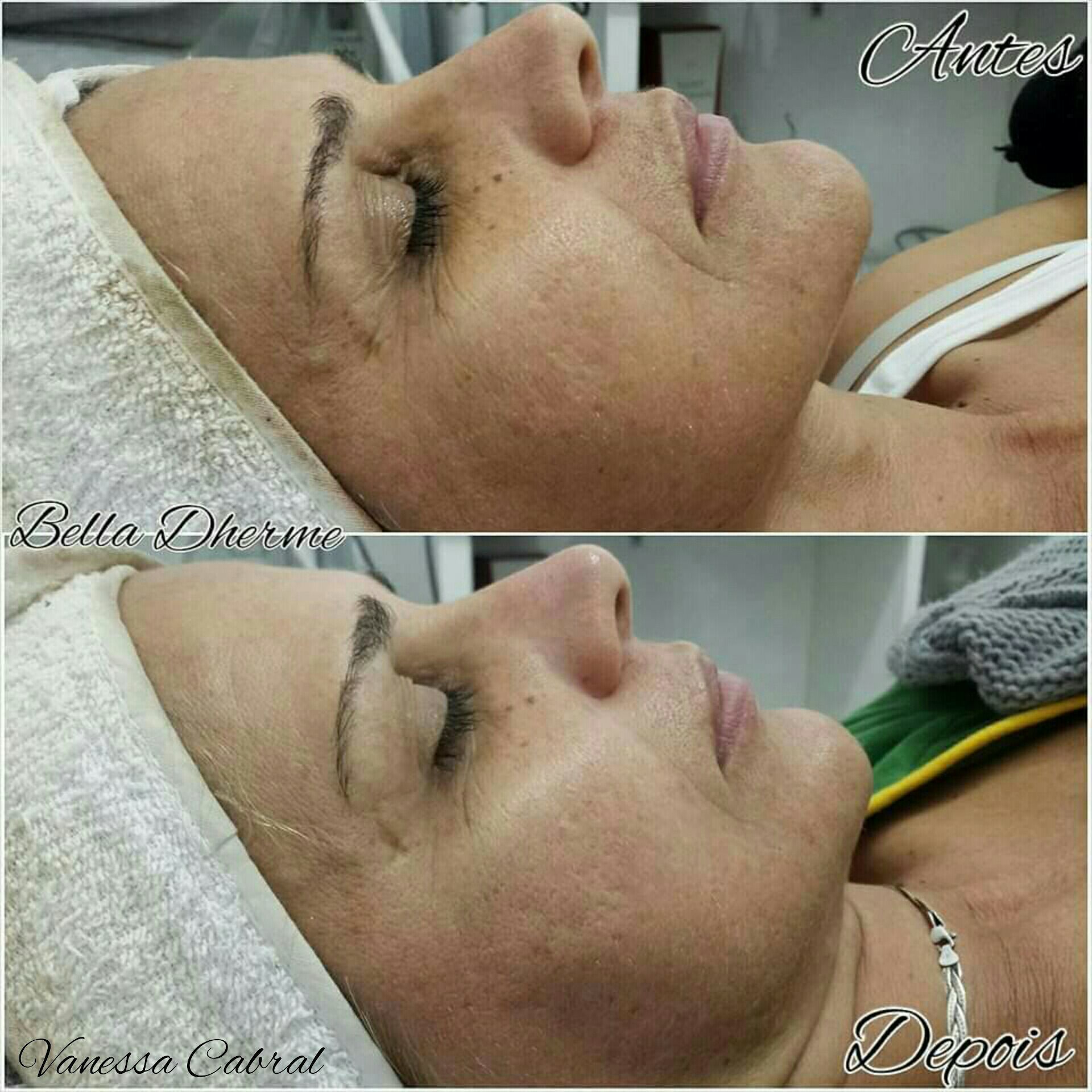 Limpeza de Pele. estética micropigmentador(a) designer de sobrancelhas