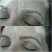Retirada com pinça e correção com sombra