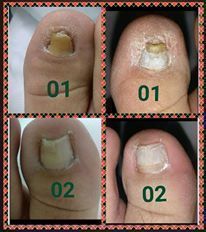 Aplicação de órtese (fibra molecular), para correção da lâmina ungueal.  podólogo(a) manicure e pedicure
